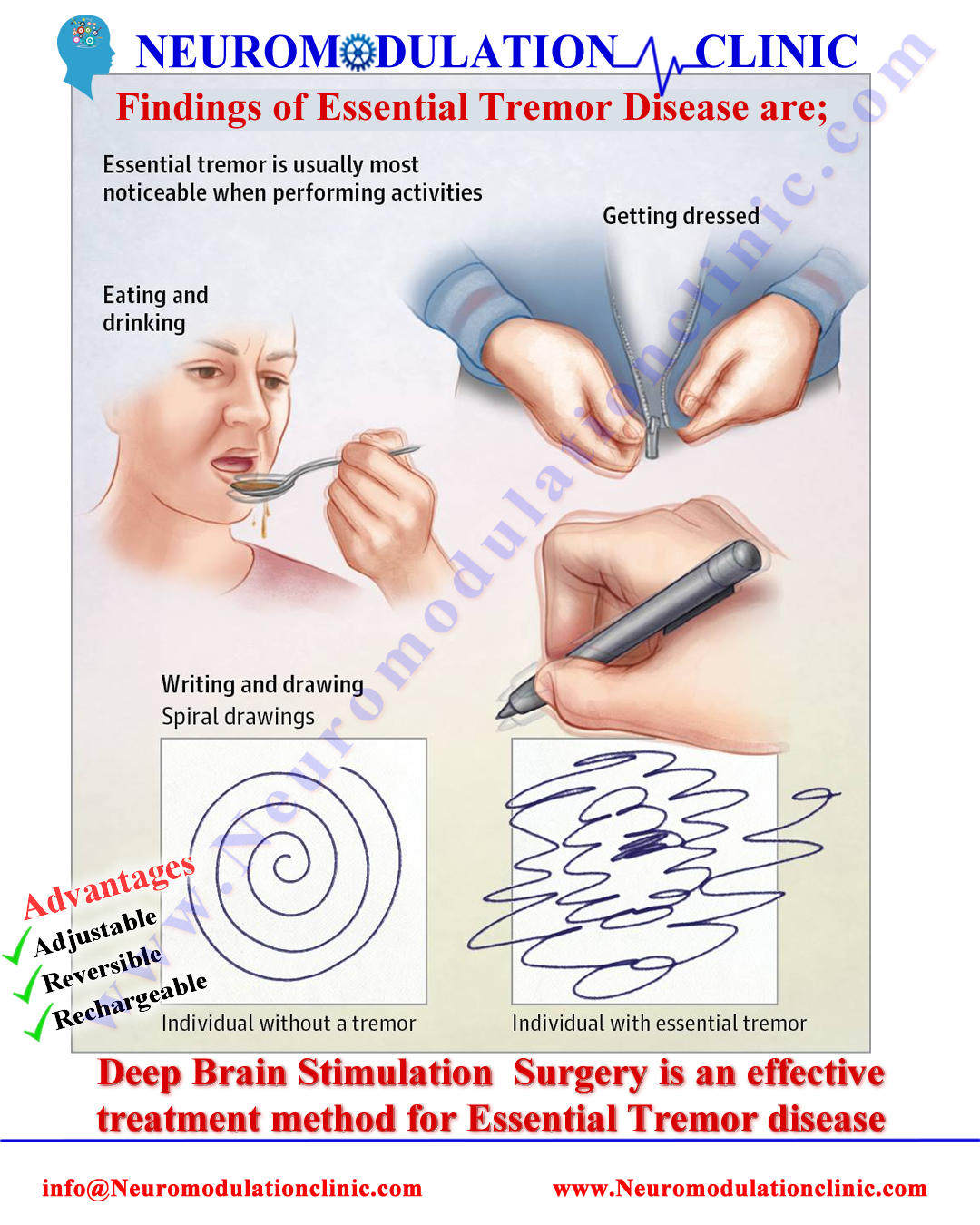 ESSENTIAL TREMOR