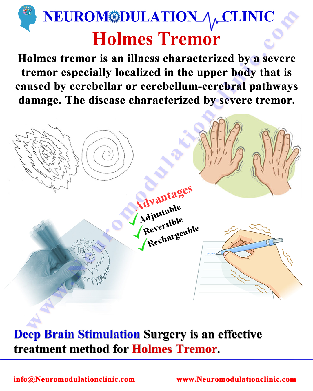 HOLMES TREMOR 