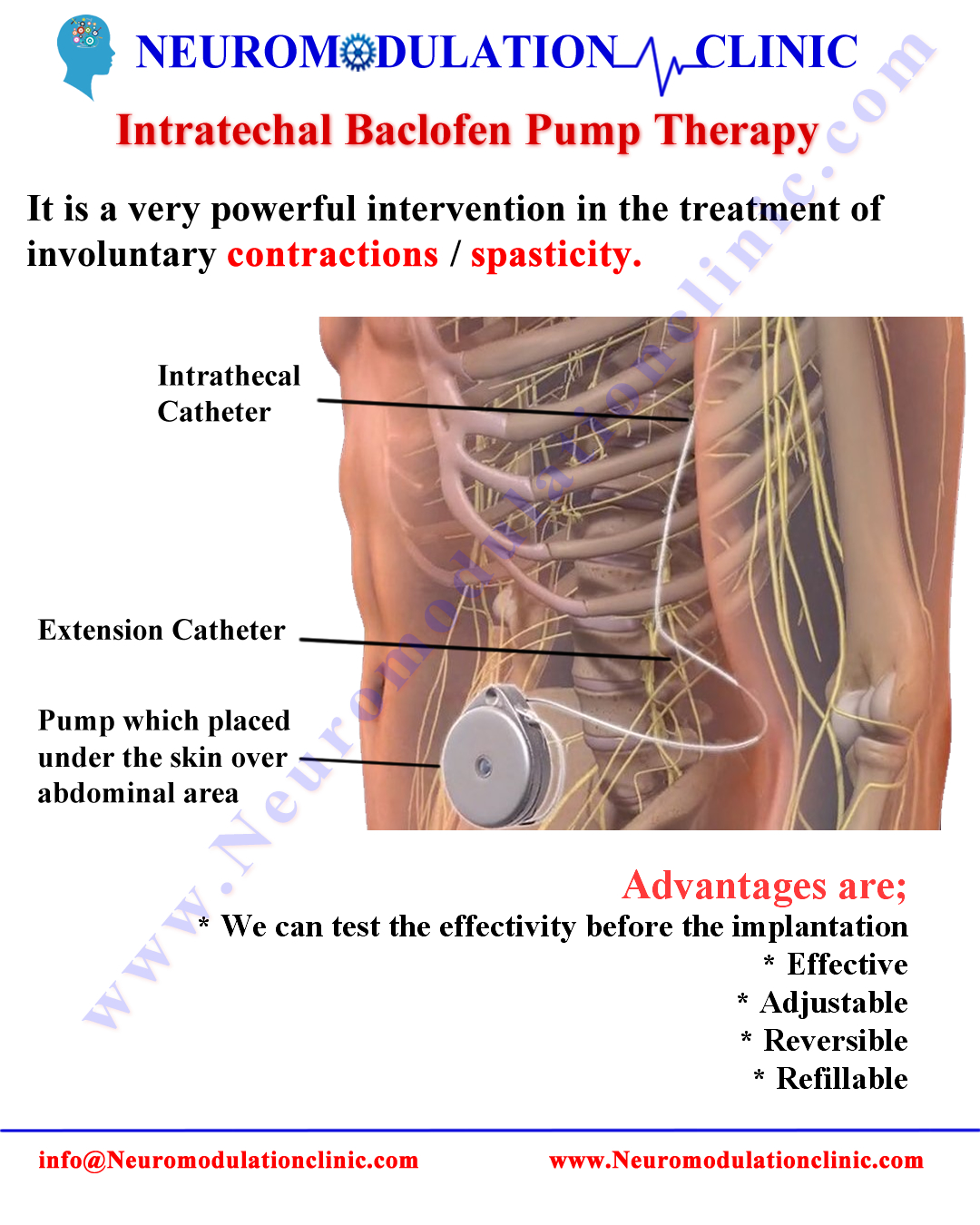 INTRATHECAL BACLOFEN PUMP