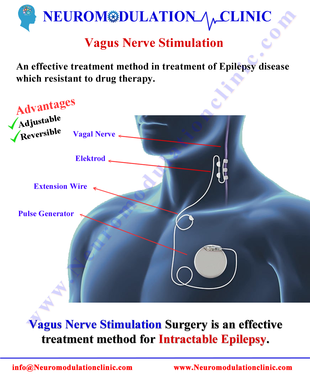 Neurology : Vagus nerve stimulation