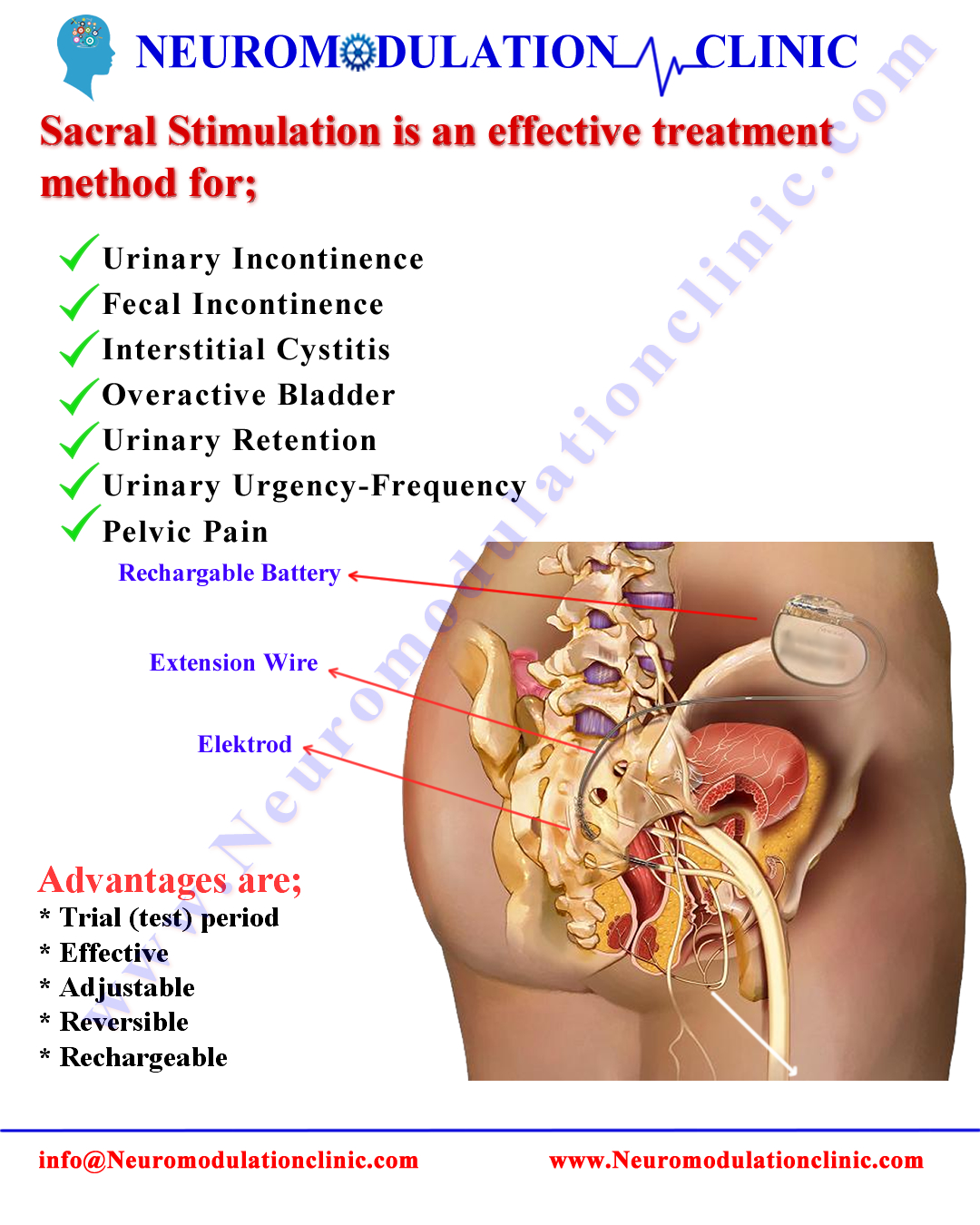 SACRAL NERVE STIMULATION