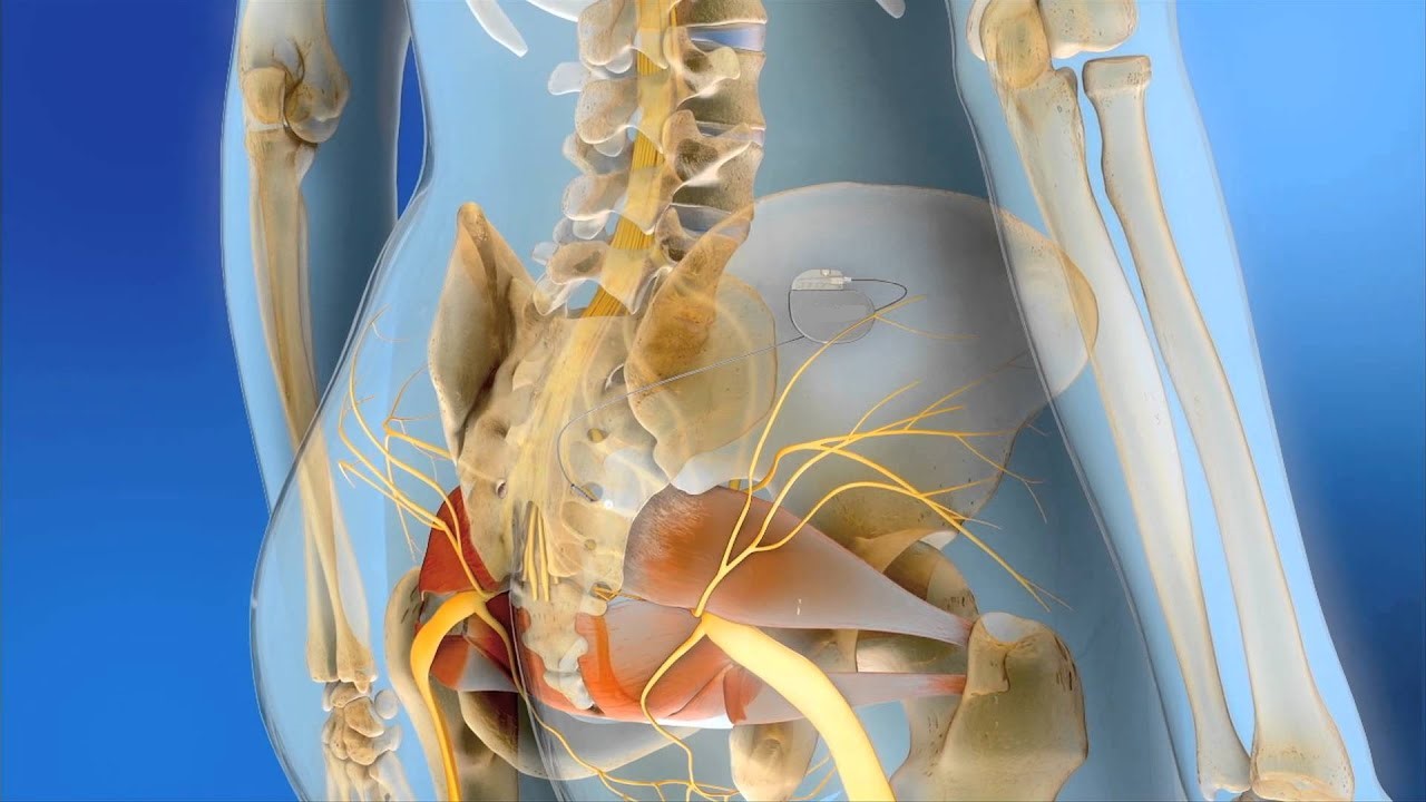 Sacral Nerve Stimulation
