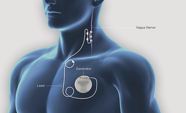 Vagus Nerve Stimulation